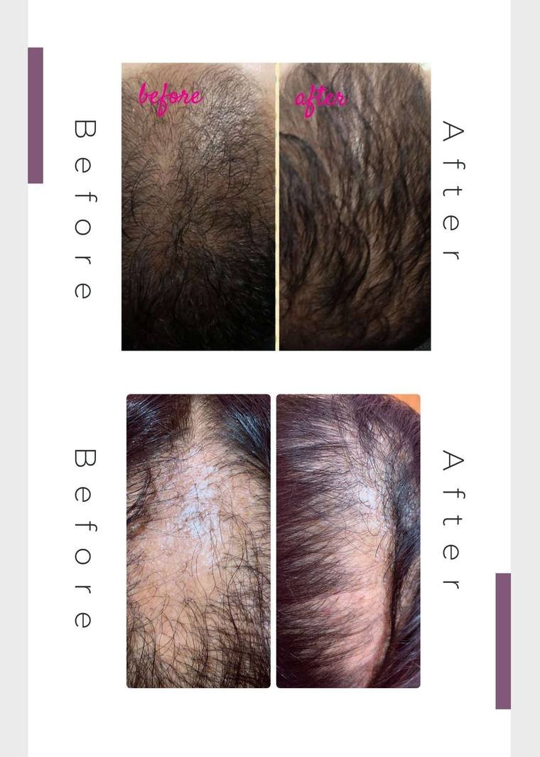 Hair restoration result