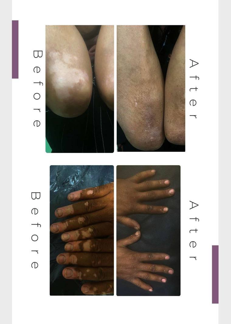 Vitiligo treatment result